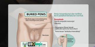 Buried Penis: Penis ‘mendelep’ tersembunyi: Kelainan yang Sering Terabaikan Buried penis - urologis.com