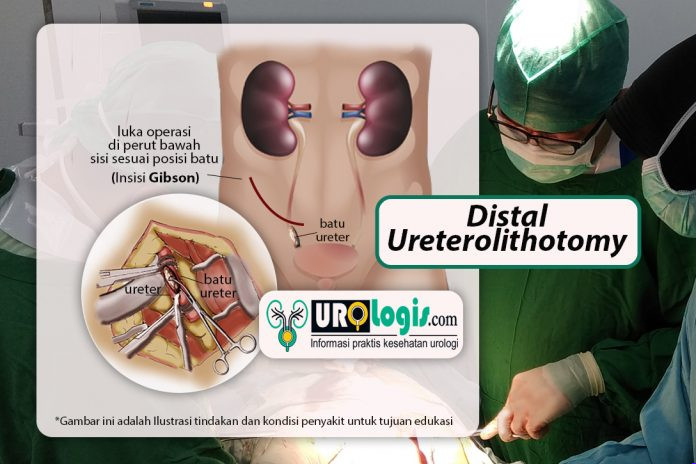 Distal Ureterolithotomy - urologis.com
