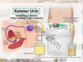 Kateter kencing: Foley Catheter/Indwelling Urethral Catheter (2 way catheter) Foley Catheter (2 way catheter) - urologis.com