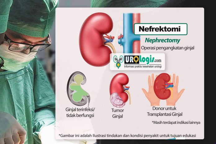 Nephrectomy - urologis.com
