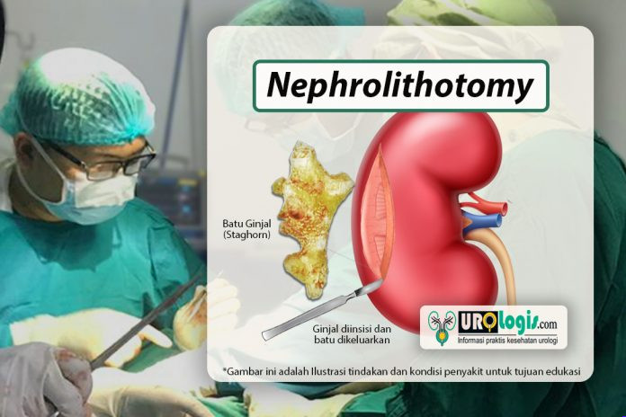 Nephrolithotomy - urologis.com