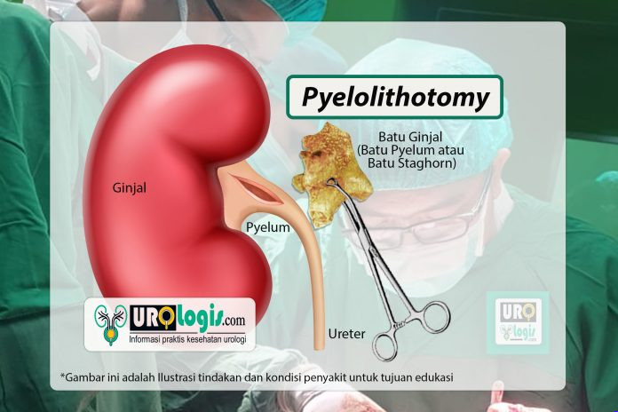 Pyelolithotomy - urologis.com