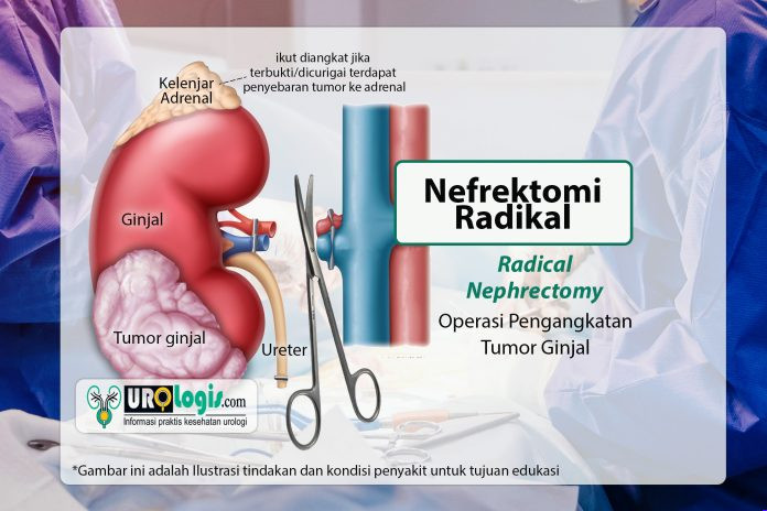 Nefrektomi Radikal - urologis.com