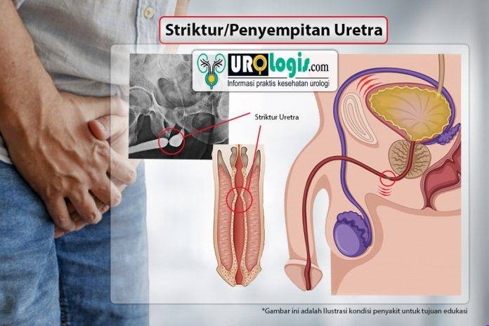 Striktur Uretra - urologis.com