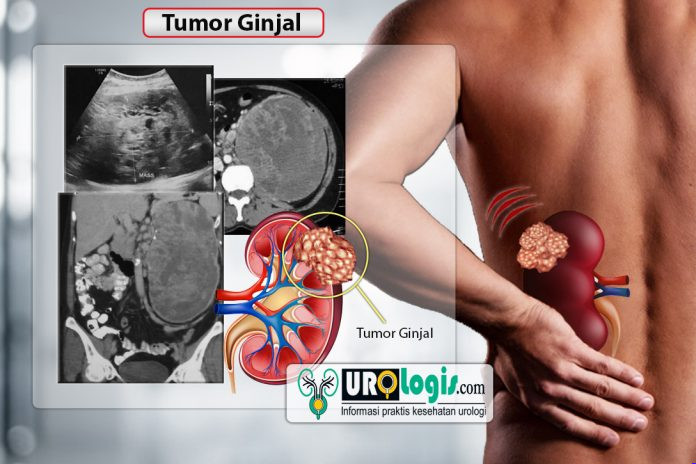 Tumor Ginjal - urologis.com