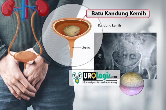 Batu Kandung Kemih - urologis.com
