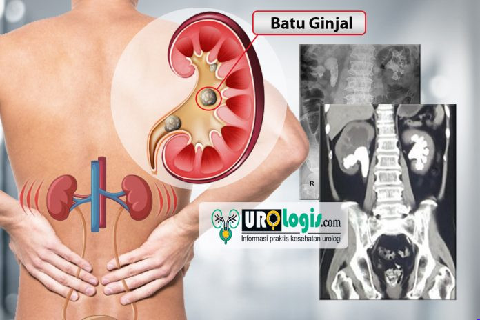 Batu Ginjal - urologis.com