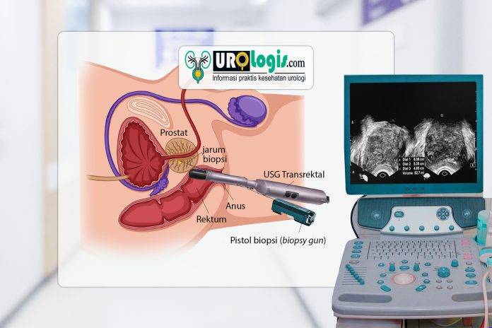 biopsi prostat - urologis.com