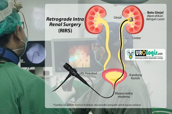 RIRS - urologis.com