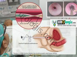 Direct Visual Internal Urethrotomy (DVIU)/Optical Urethrotomy/Sachse : Pelebaran saluran uretra tanpa sayatan luar DVIU (Internal Urethrotomy) - urologis.com