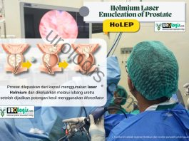 HoLEP (Holmium Laser Enucleation of the Prostate): Solusi Modern untuk Pembesaran Prostat Jinak HoLEP